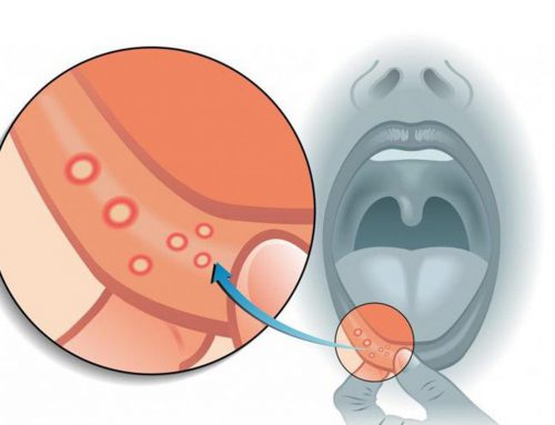 Ar verta sunerimti pastebėjus šias žaizdeles savo burnos ertmėje?